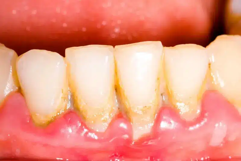 diş taşı nedir neden oluşur